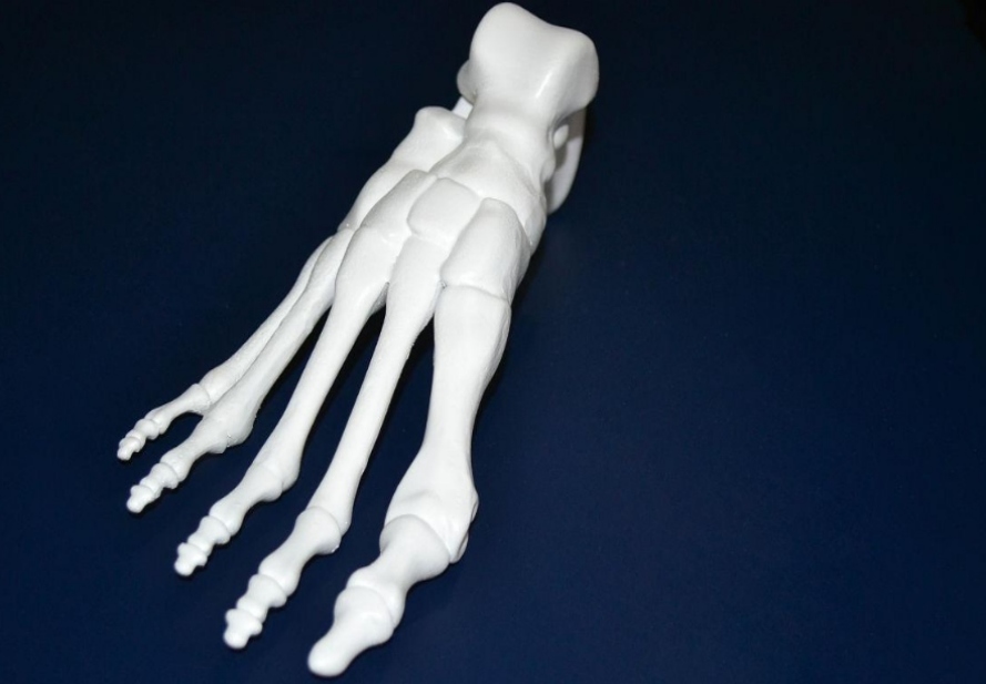 3D打印骨骼模型給患者的康復指南