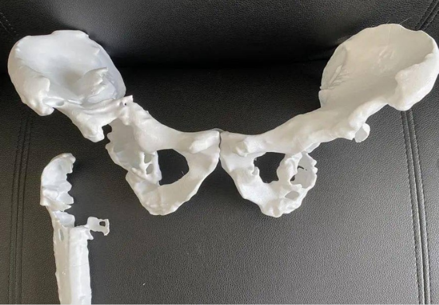 3D打印椎骨給脊柱手術裝個安全保險